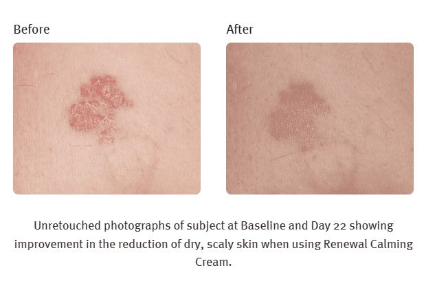 Renewal Calming Cream 8 oz.